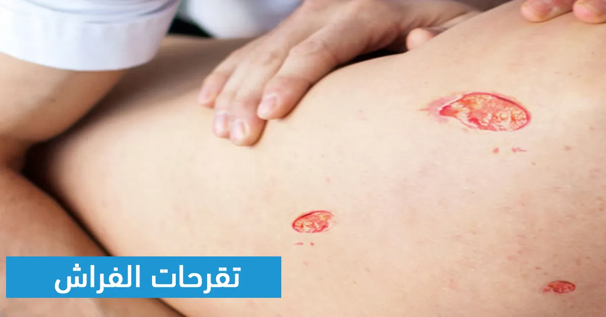 تقرحات الفراش